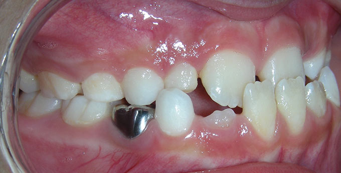 Child's teeth, right side view before orthodontic treatment for an underbite (Negative overjet) 